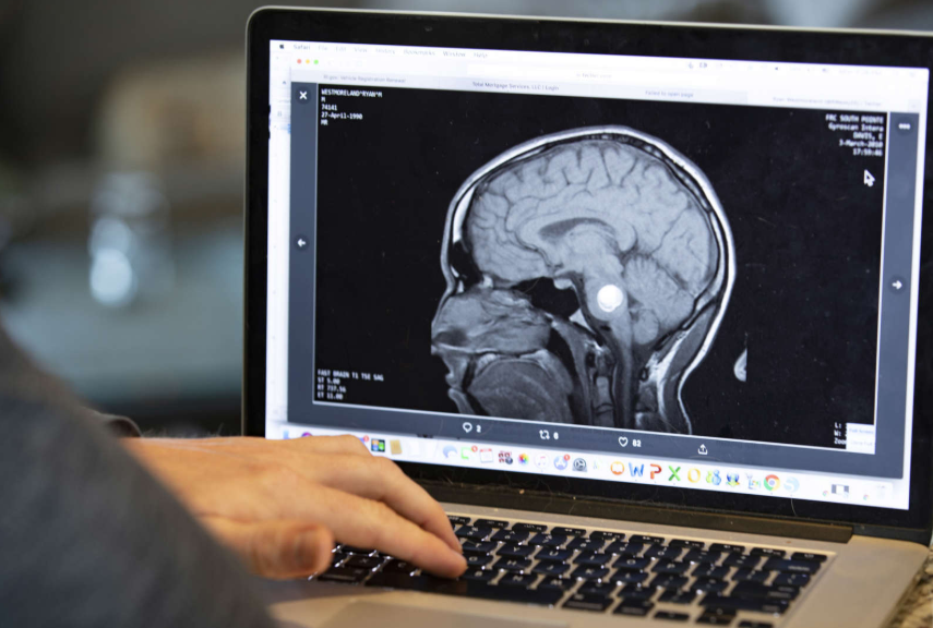 Why Does COVID-19 Cause Brain Fog?